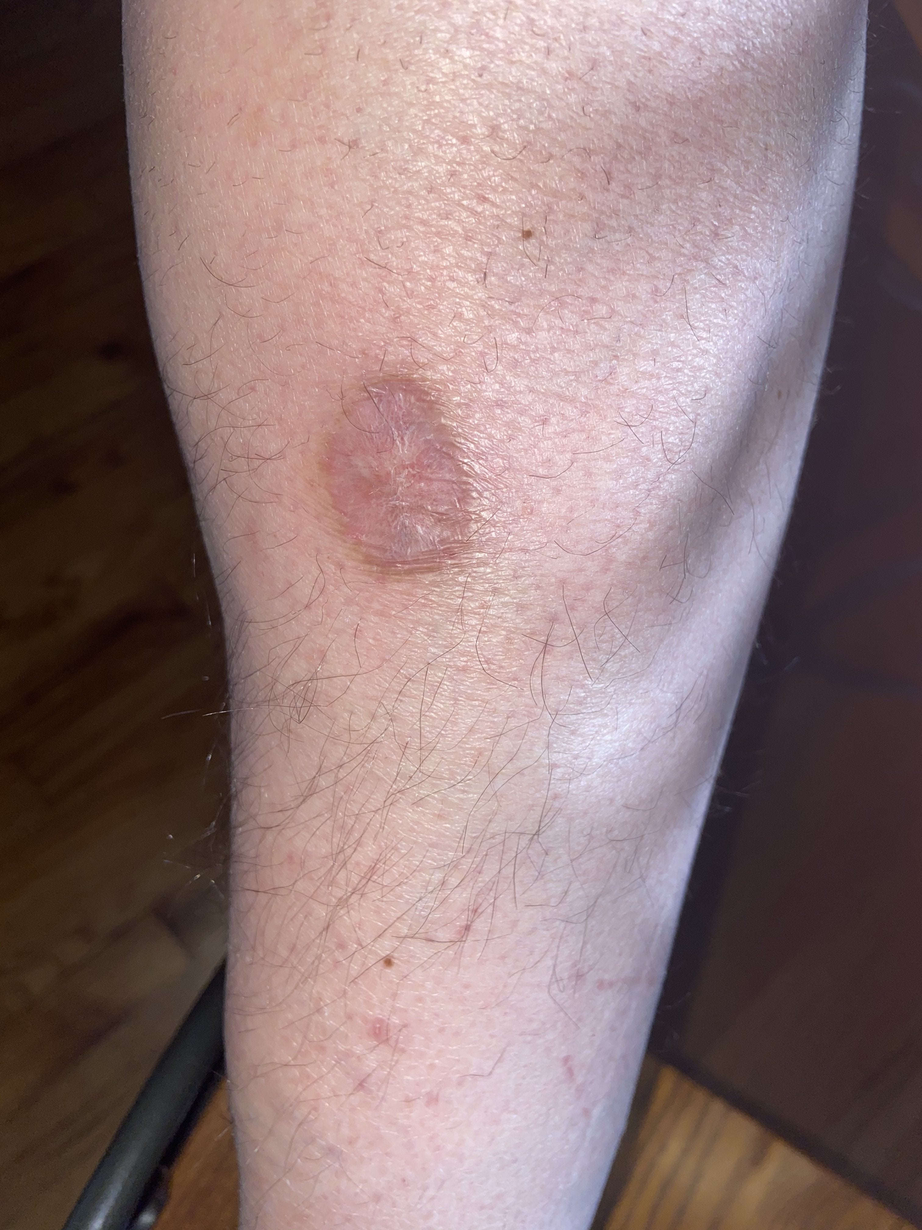 Michigan Brown Recluse Spider Bite Or “suspected” Bite True Story